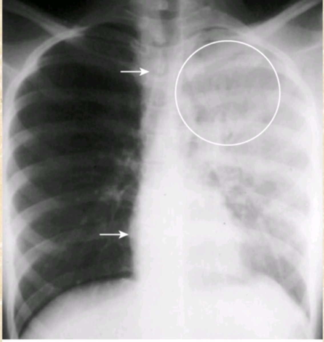 <p>What does this CXR show? How do you know?</p>