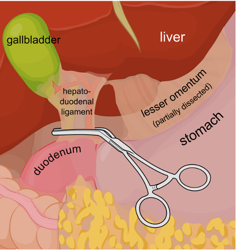 <p><strong><u>What:</u> </strong><span style="color: blue"><strong>First part </strong></span>of <span style="color: blue"><strong>small intestine</strong></span></p><p><strong><u>Location:</u> </strong><span style="color: blue"><strong>Extend</strong></span><strong> </strong>from <span style="color: blue"><strong>pylorus</strong></span><strong> </strong>to <span style="color: blue"><strong>beginning</strong></span><strong> </strong>of <span style="color: blue"><strong>jejunum</strong></span><strong> </strong></p><p><strong><u>Describe its mesentery:</u> </strong><span style="color: blue"><strong>Short</strong></span><strong> </strong>except in carnivores</p><p><strong><u>Cranial part closely related to:</u> </strong><span style="color: blue"><strong>Liver</strong></span><strong> </strong>and <span style="color: blue"><strong>pancreas</strong></span></p><ul><li><p><strong><u>Forming:</u> </strong><span style="color: blue"><strong>Sigmoid loop</strong></span><strong> </strong>in <span style="color: blue"><strong>horse, ruminants</strong></span><strong> </strong>and <span style="color: blue"><strong>pigs</strong></span></p></li></ul><p><strong><u>Attach to:</u> </strong><span style="color: blue"><strong>Liver</strong></span><strong> </strong>by <span style="color: blue"><strong>hepatoduodenal ligament</strong></span></p><p><strong><u>Function:</u> </strong><span style="color: blue"><strong>Receives bile ducts</strong></span><strong> </strong>and <span style="color: blue"><strong>pancreatic ducts </strong></span></p><p></p>