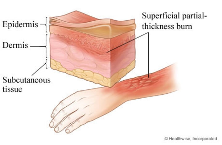 <p>•the epidermis & upper regions of dermis damaged</p><p>•Symptoms mimic first degree burns, but blisters also appear</p>