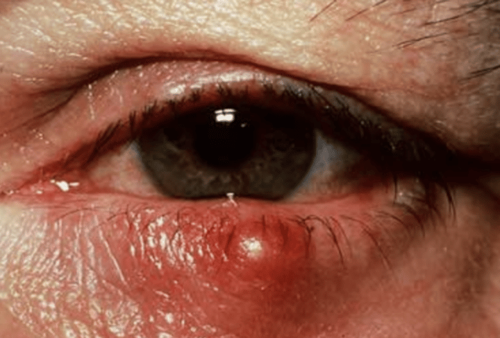 <p>Clogged pore around eye</p>