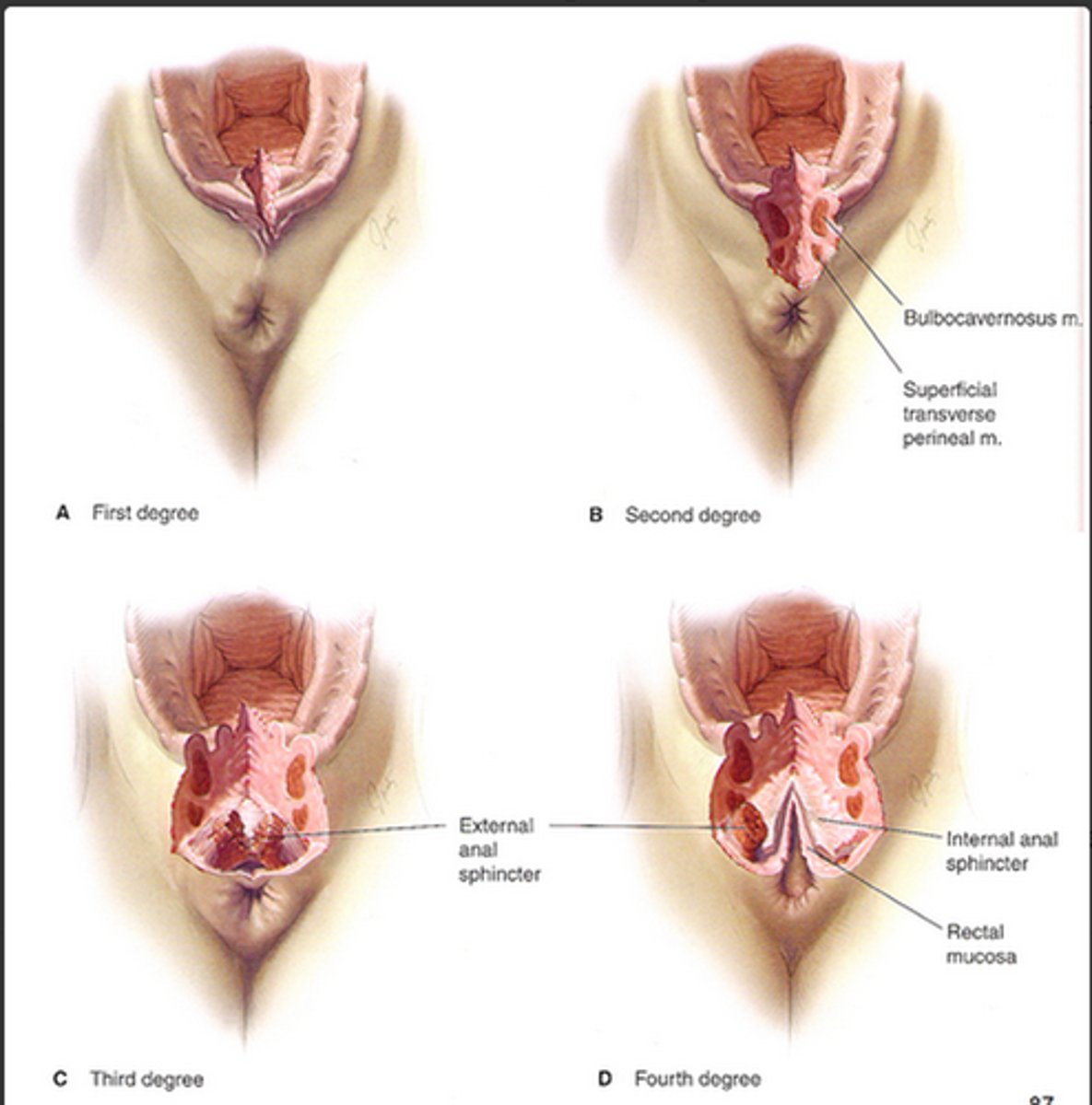 <p>Grade is the appearance (how aggressive/abnormal the cells look); Stage is the extent (how far the cancer has physically spread</p>