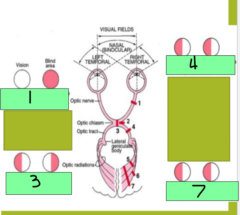 <p>4 - Destruction of one optic tract causes which visual pathway dysfunction?</p>