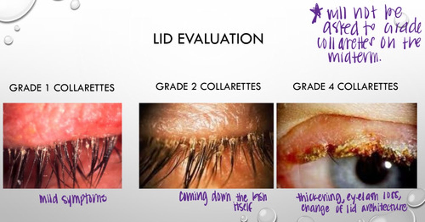 <p>What are possible symptoms of Grade 4 collarettes?</p>