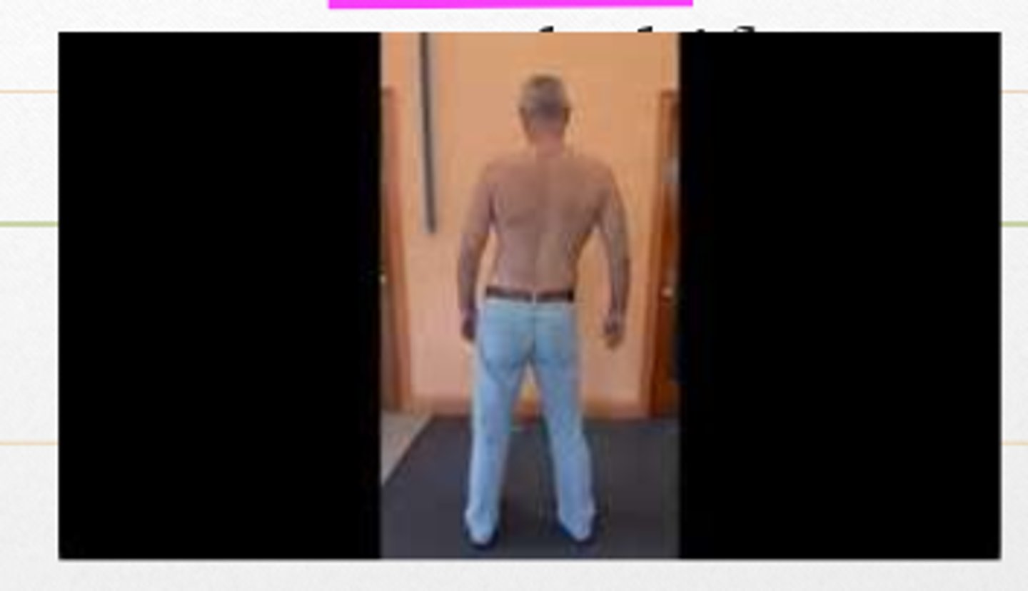 <p>shifting of the trunk either toward or away from the painful side</p><p>*depends where bulging lumbar disc is</p>