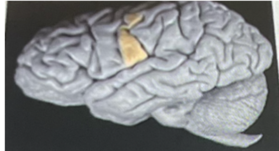 <p>The highlighted section above if damaged will interfere (postcentral gyrus highlighted)</p><p>a. motor functions</p><p>b. sensory perception such as feeling pain</p><p>c. spinal reflex</p><p>d. visual functions</p><p>e. auditory functions</p>