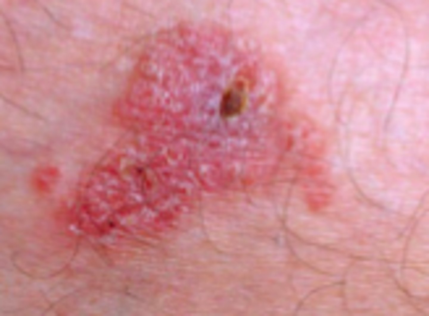 <p>Neoplasms:</p><p>- type of SCC</p><p>- erythematous, well-demarcated, scaly patch or plaque located in sun-exposed areas</p>