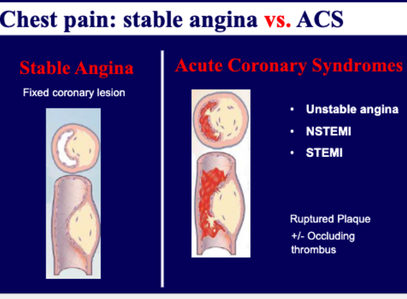 <ul><li><p>stable → fixed coronary lesions</p></li><li><p>acute  → ruptured plaque + occluding thrombus</p><ul><li><p>unstable angina</p></li><li><p>NSTEMI/STEMI (myocardial infarction)</p></li></ul></li></ul><p></p>