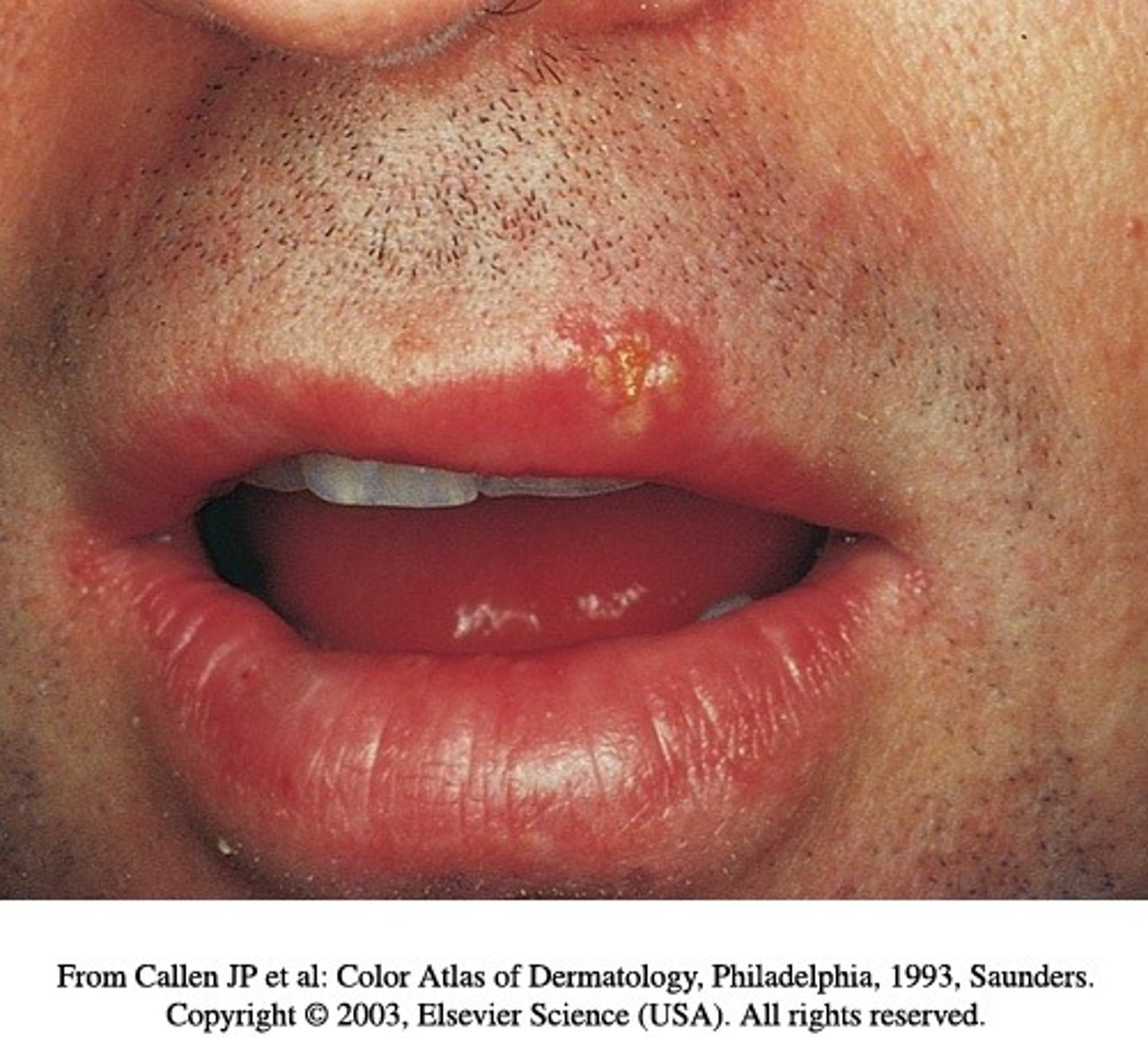 <p>Oral herpes (cold sores)</p>