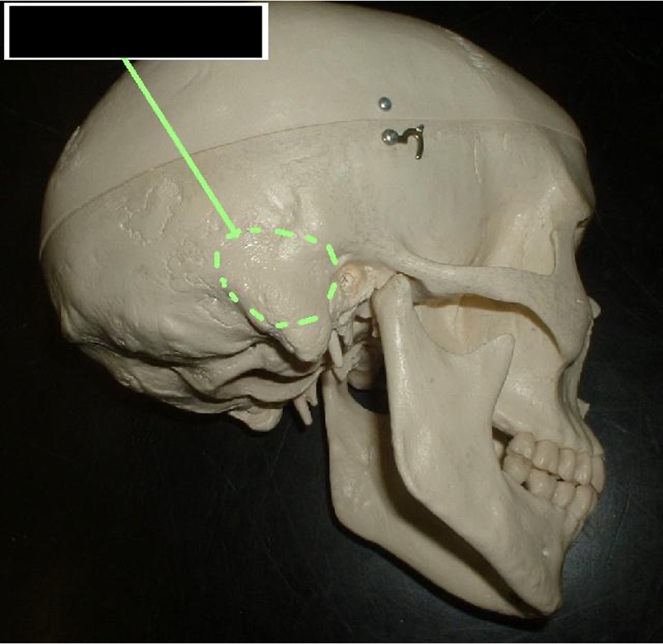 <p>bump behind ear hole</p>