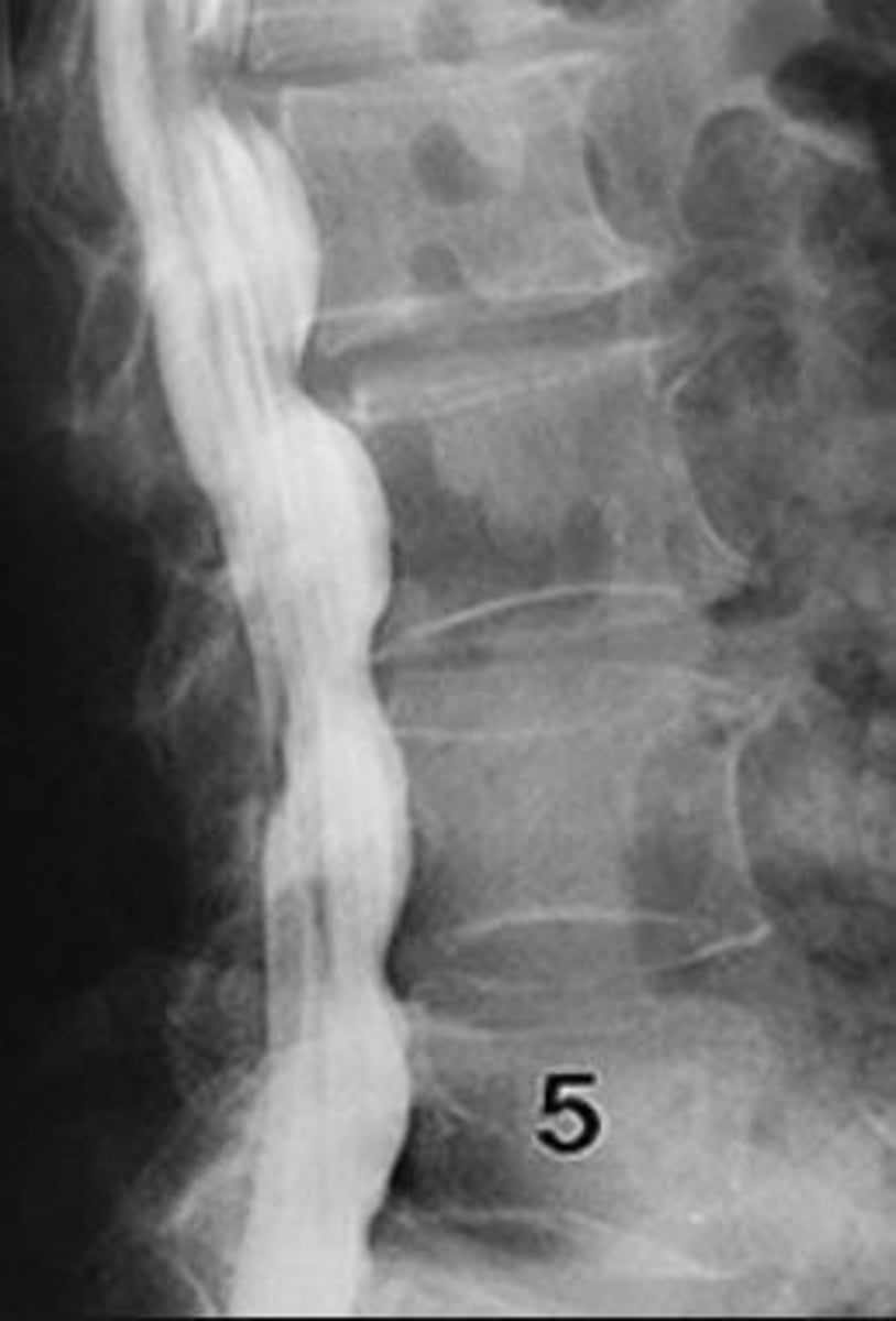 <p>radiographic study of spinal cord &amp; its nerve root branches w/ contrast medium</p>