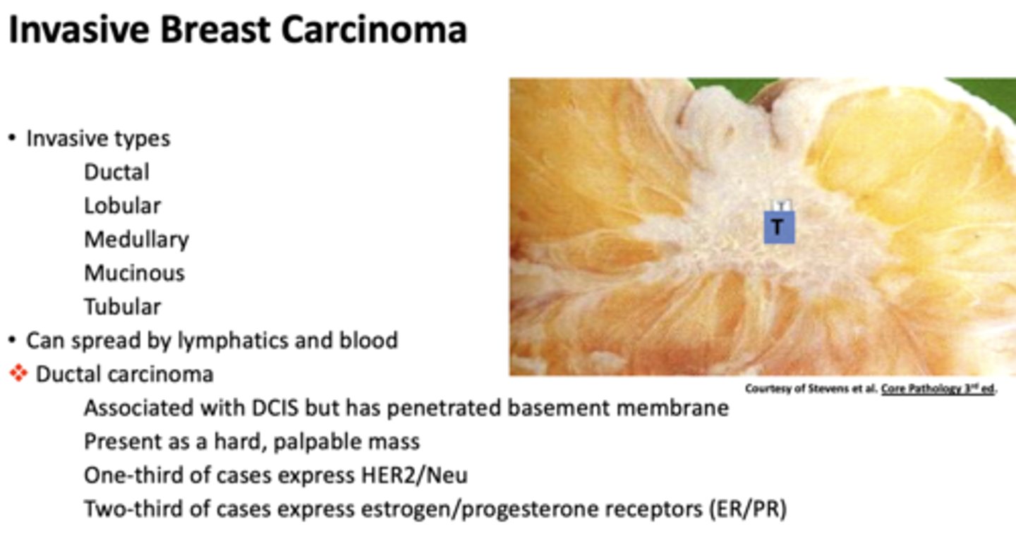 <p>ductal carcinoma</p>
