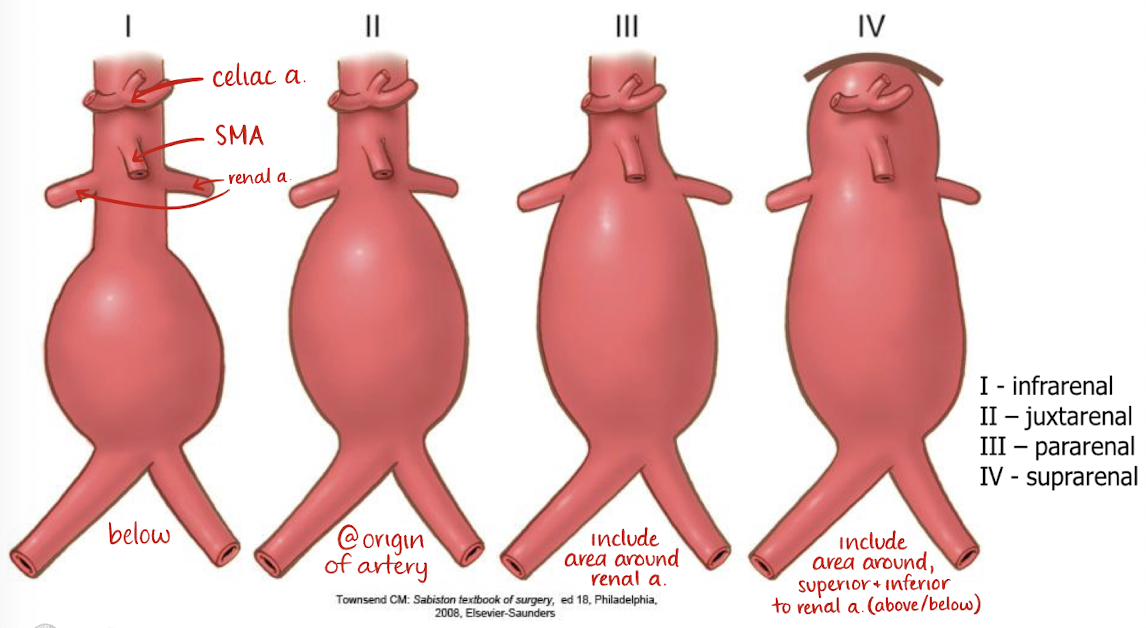 <ul><li><p>infrarenal (I)</p></li><li><p>juxtarenal (II)</p></li><li><p>pararenal (III)</p></li><li><p>suprarenal (IV)</p></li></ul><p></p>