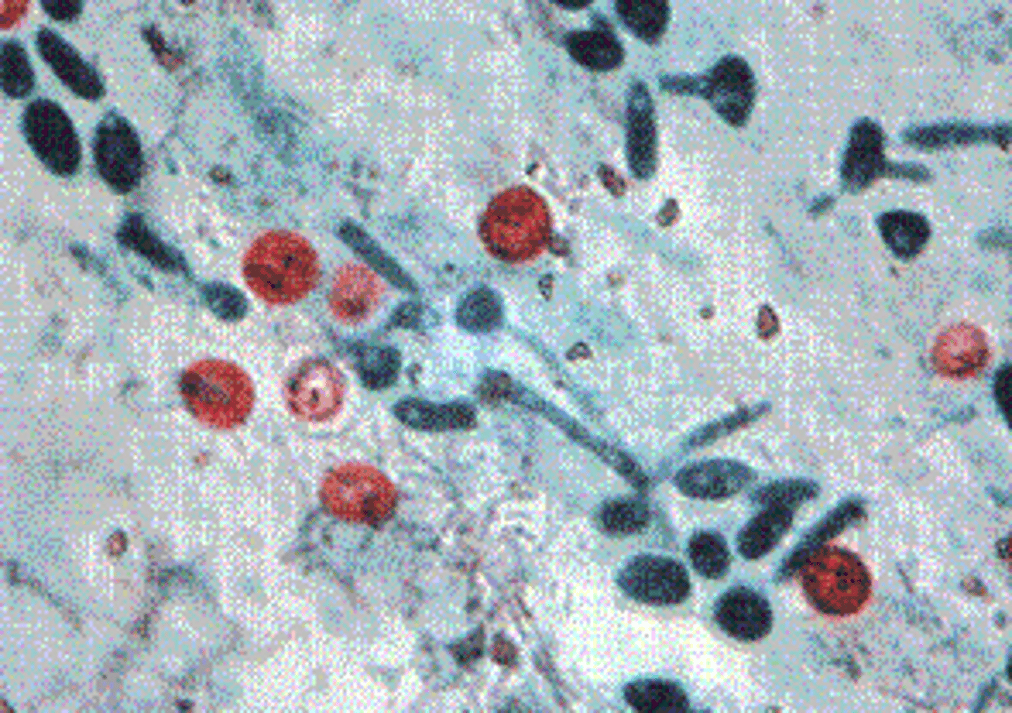 <p>a.Cryptosporidium parvum.</p><p>The recommended detection methods when Cryptosporidium infection is suspected are the modified Ziehl-Neelsen acid-fast stain and an immunofluorescent antibody test using a monoclonal antibody directed against Cryptosporidium. With the acid-fast stain, the organism stains as a bright red sphere that distinguishes it from yeasts, which stain green. </p>