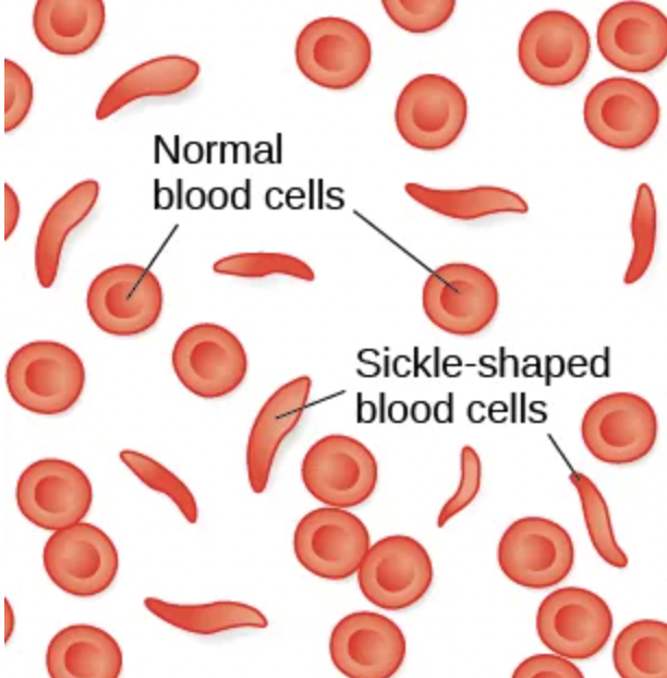 <p>-genetic condition in which red blood cells, which are normally round, take on a crescent-like shape</p><p>*changed shape affects the function (can clog blood vessels &amp; block blood flow leading to fever or tissue damage </p><p>*people have a low survival rate</p>