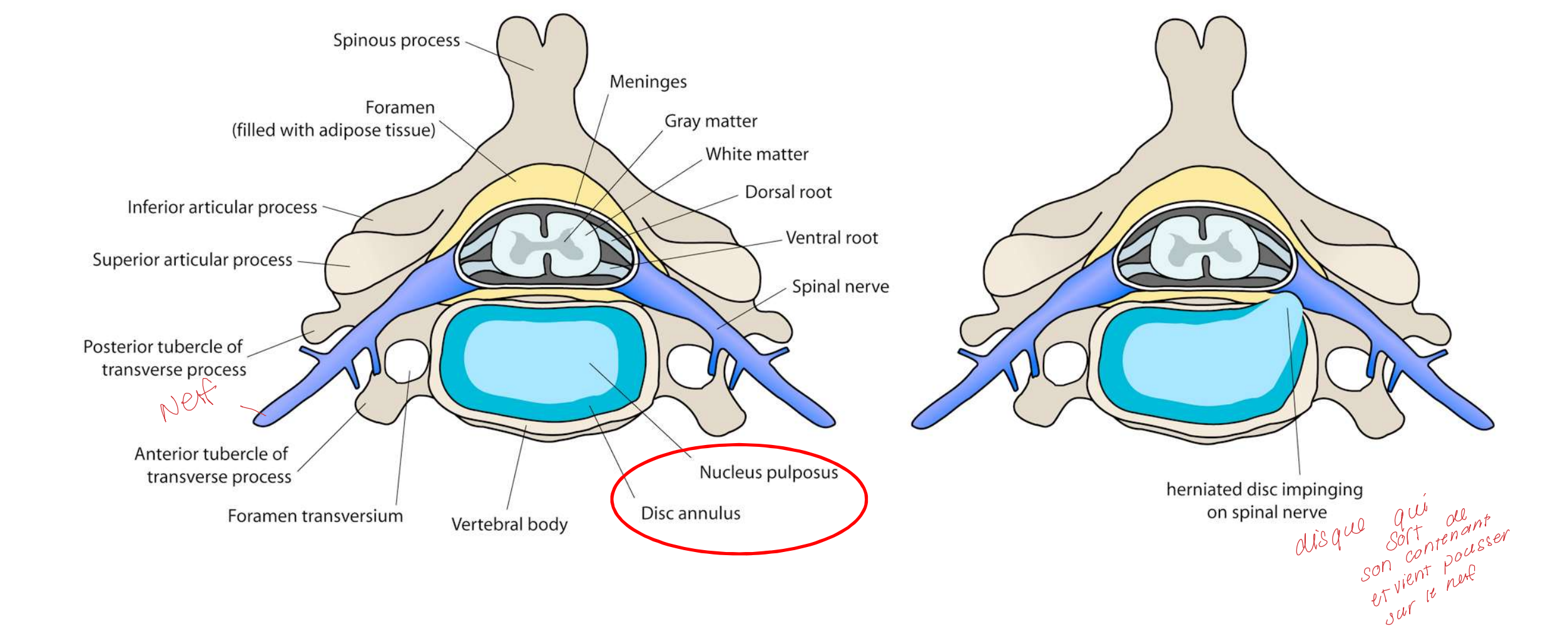 <p>Le disque sort de son contenant (corps de la vertèbre) et vient pousser sur le nerf </p>