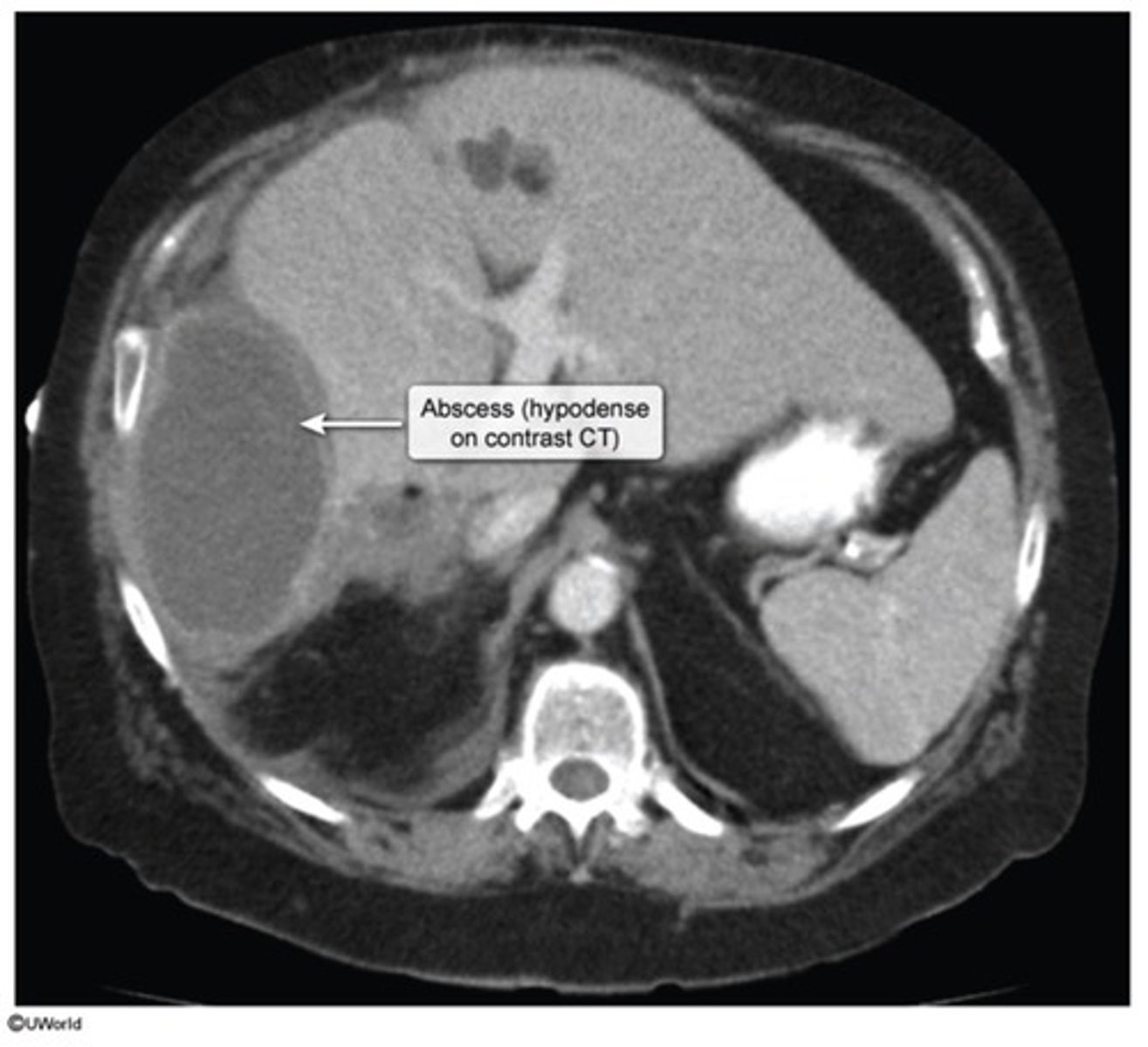 <p>Reservoir</p><p>-Anterior Nare colonization</p><p>Sx</p><p>-Osteoarthritis</p><p>-Endocarditis (Most commonly affects the Tricuspid Valve)</p><p>-Skin + Tissue (I.e. Hepatic) Abscess</p><p>-Scalded Skin Syndrome</p><p>-Hepatic Fluid-filled Cavity/Abscesses (D/t Hematogenous spread)</p><p>-Right-sided Endocarditis</p><p>-Toxic Shock Syndrome</p><p>-Bullous Impetigo (Honey-crusted blistering skin rash)</p><p>**Immune response is mediated by Neutrophils + B-cells**</p>