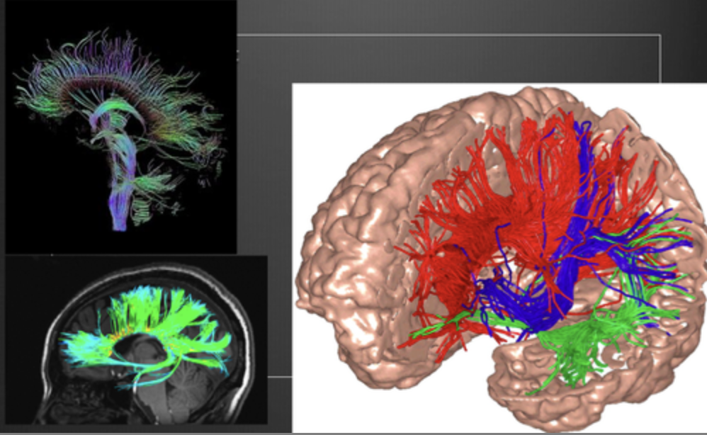 DTI (diffusion tensor imaging) structural disadvantages