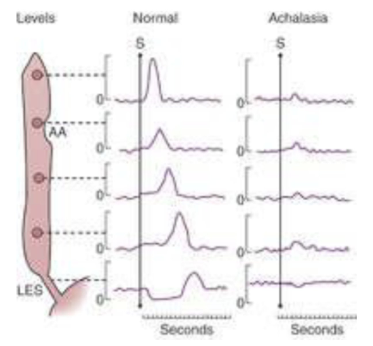 <p>what would a graph tracking the change in pressure during the process of swallowing food down the esophagus look like in achalasia (in comparison to baseline)?</p>