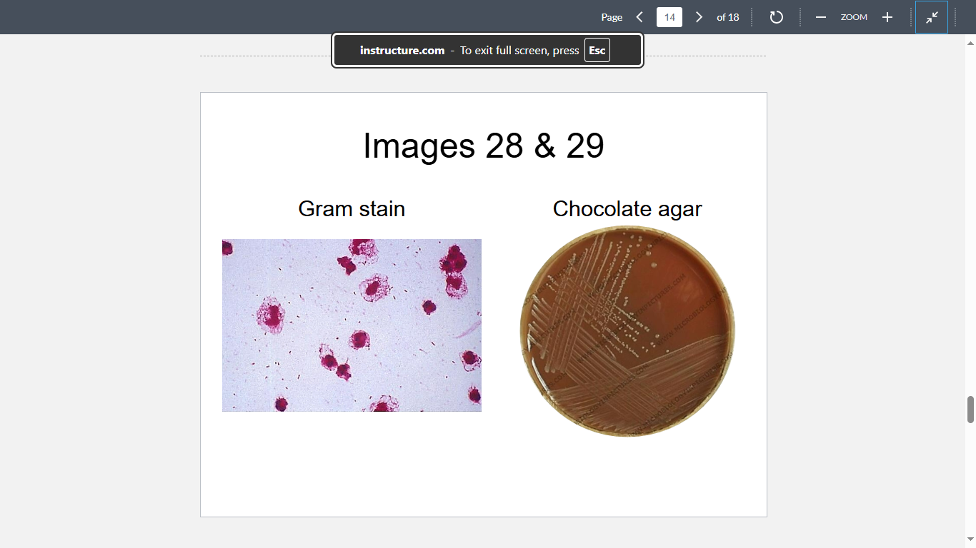<p>A 20-year-old man is diagnosed with severe otitis media accompanied by purulent drainage from the ear canal. Culture of the material yields bacteria with “musty basement” odor, depicted in Images 28 & 29. The isolate grows along the Staphylococcus aureus streak line when plated on blood agar. What is the most likely cause?</p>