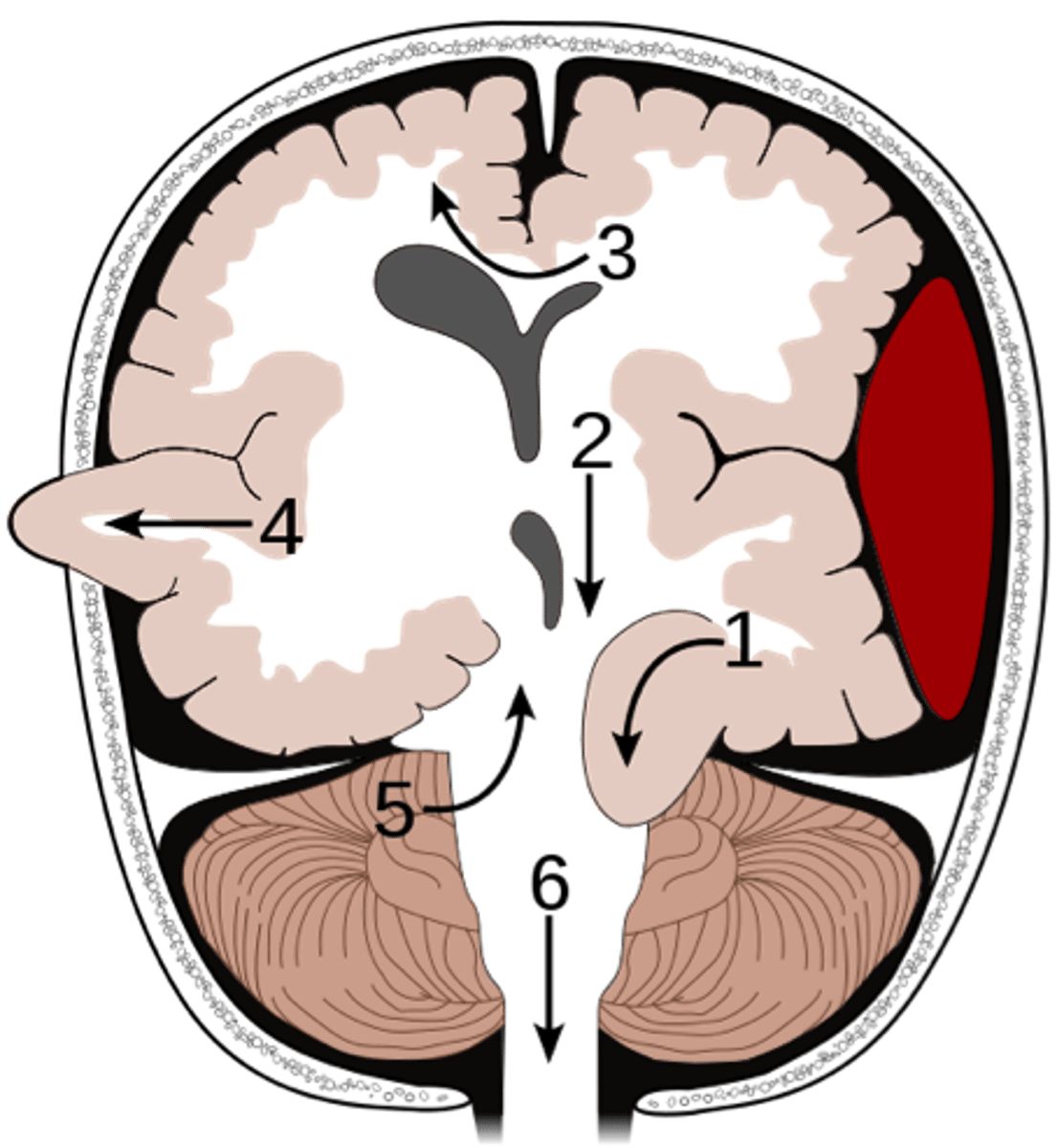<p>transtentorial herniation where the midbrain is push upward into the cerebrum (5)</p>