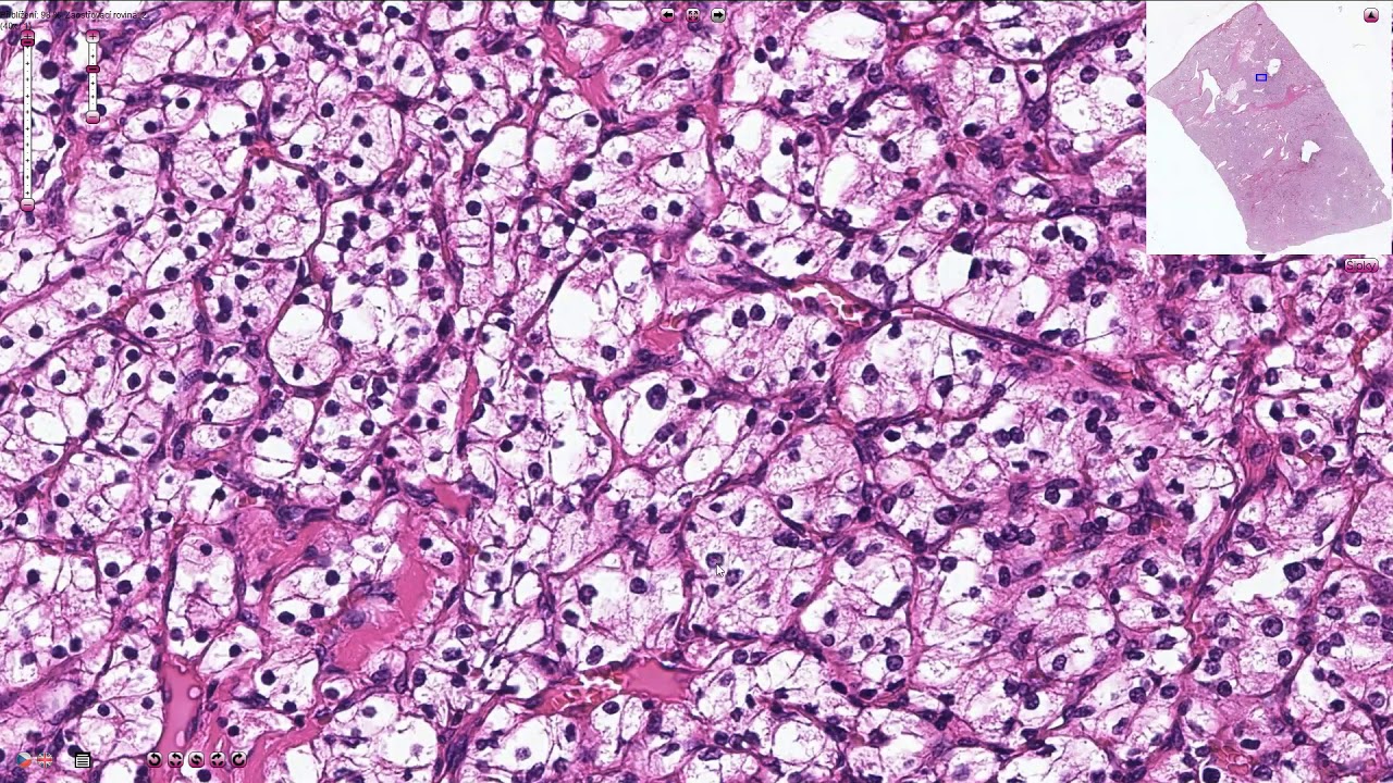 SUBTYPE: CLEAR CELL CARCINOMA
Polygonal clear cells filled with accumulated lipids and carbohydrate