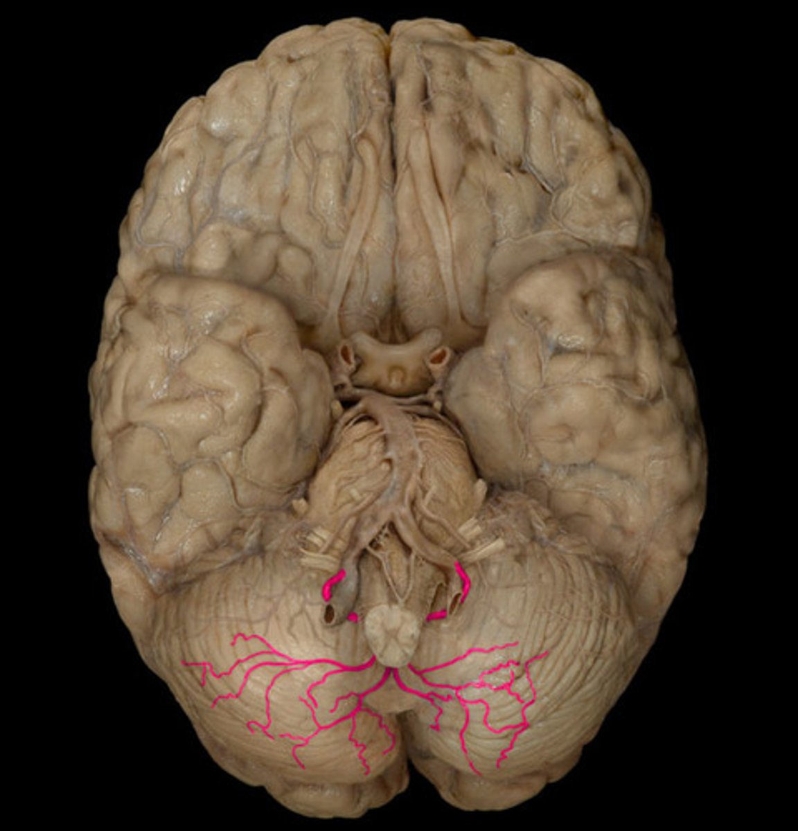 <p>posterior inferior cerebellar artery</p>