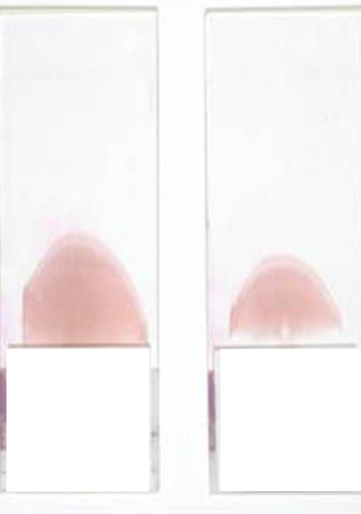 <p>What is this blood film appearance, and what is the cause/solution?</p>