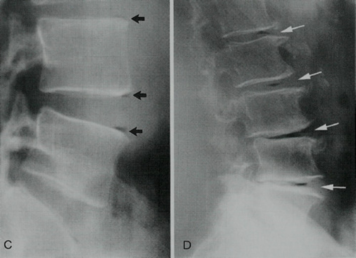 <p>gradual breakdown of spinal discs due to aging, wear and tear, or injury.</p><p>- Discs lose water, shrink, and become less flexible, leading to pain, stiffness, and reduced mobility.</p>