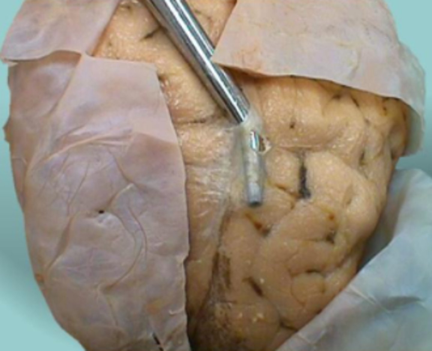 <p>Middle layer of the meninges named for the spider-web-like trabeculae that extend between it and the pia mater</p>