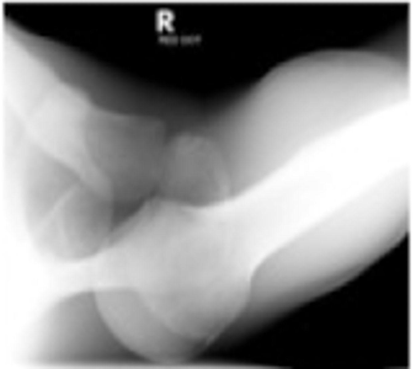 <p>humeral head will move towards the acromion and away from the ribs</p>