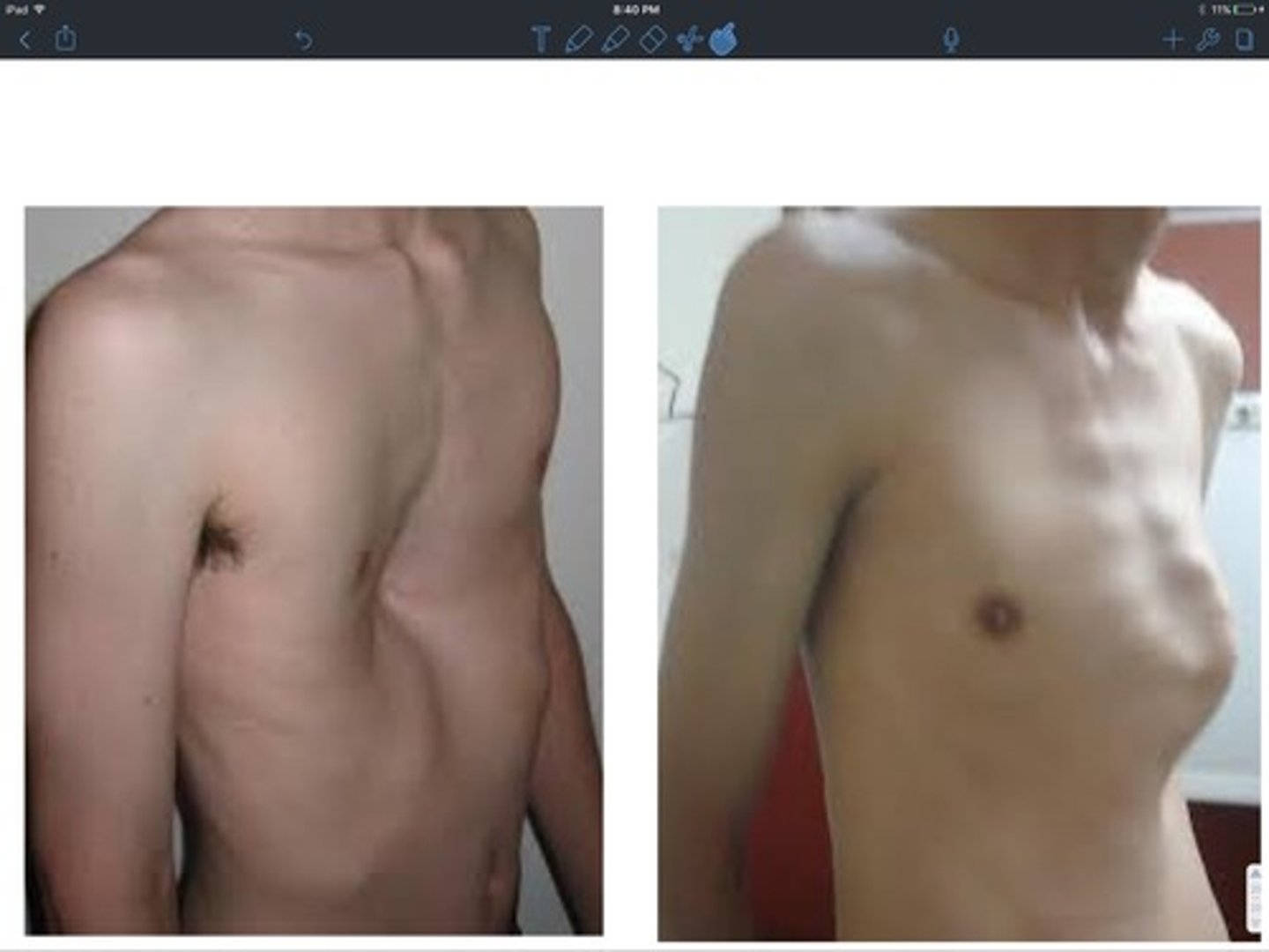 <p>- pigeon: sternum and ribs protrude anterior</p><p>- funnel: project posterior</p>