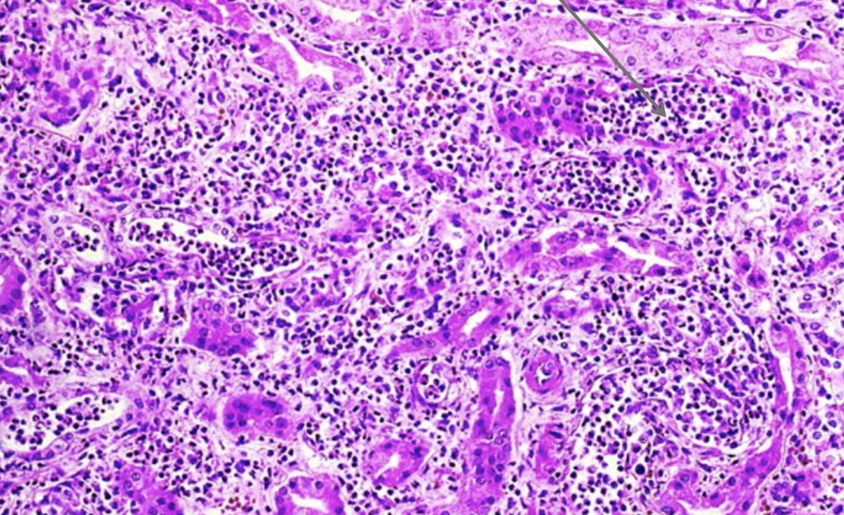 <p>What type of cell is very prominent in this image? What does it indicate?</p>