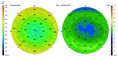 <p>epithelial thinning over apex of cornea</p>