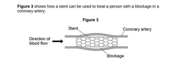 <p>Explain how a stent works as a treatment for a person with a blockage in a coronary artery.(2)</p>