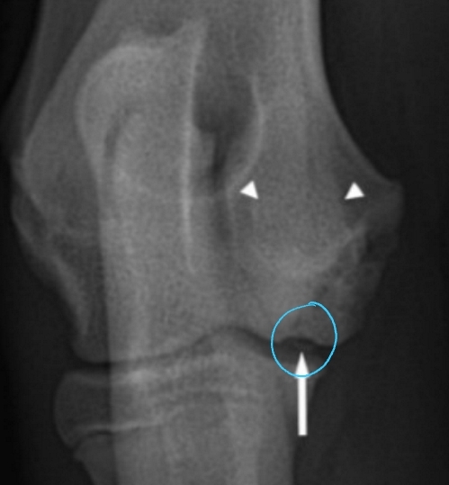 <ul><li><p><span style="background-color: transparent;"><strong><span>Et: </span></strong><span>Defect of normal endochondral ossification</span></span></p><ul><li><p><span style="background-color: transparent;"><span>Shoulder </span></span></p></li></ul></li></ul><ul><li><p><span style="background-color: transparent;"><strong><span>Sig:</span></strong><span> large breed dogs, rapid growth, 5-10 months</span></span></p></li></ul><ul><li><p><span style="background-color: transparent;"><strong><span>Cs: </span></strong><span>lameness, pain, decreased ROM, muscle atrophy, effusion</span></span></p></li></ul><ul><li><p><span style="background-color: transparent;"><strong><span>Dt: </span></strong></span></p><ul><li><p><span style="background-color: transparent;"><strong><span>Rads:</span></strong><span> Divot of subchondral bone, OA, free cartilage flap</span></span></p></li><li><p><span style="background-color: transparent;"><strong><span>CT: </span></strong><span>Detects subtle subchondral bone lesions</span></span></p></li></ul></li></ul><ul><li><p><span style="background-color: transparent;"><strong><span>Tx: </span></strong><span>Arthrotomy or arthroscopy</span></span></p><ul><li><p><span style="background-color: transparent;"><span>Remove cartilage flap, debride subchondral bone, promote fibrocartilage repair</span></span></p></li></ul></li></ul><p></p>