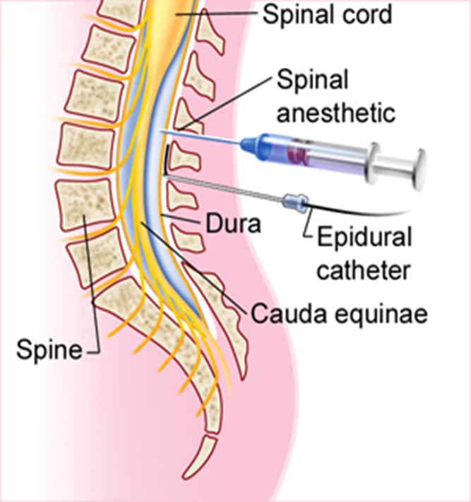 <p>what are the most common procedures done with the <span>spinal “intrathecal” route</span></p>