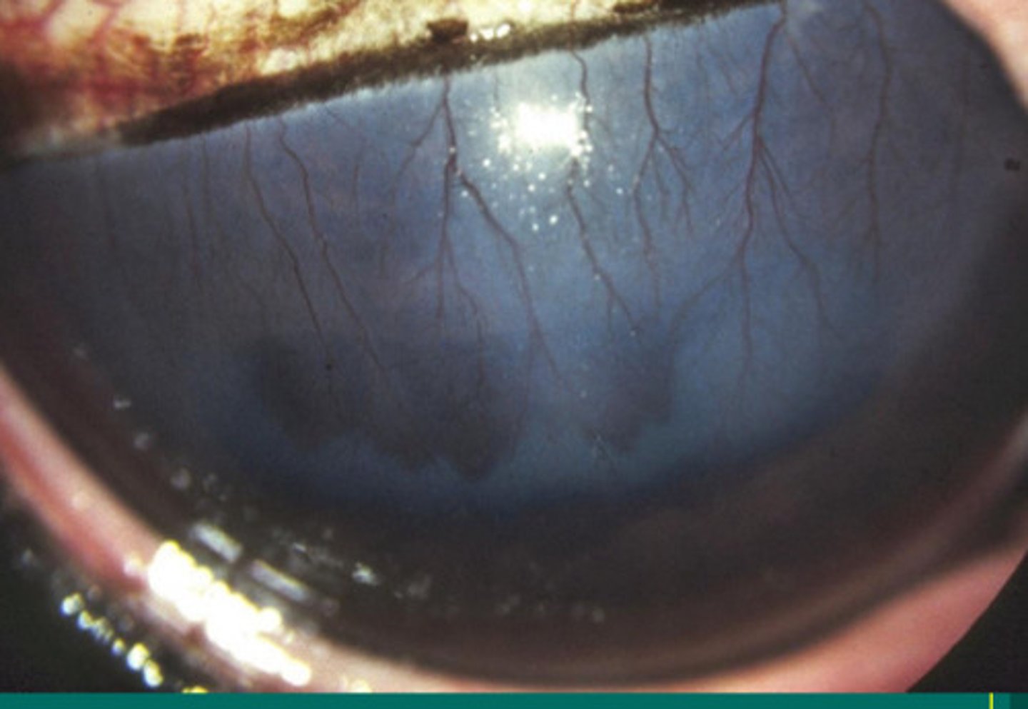 <p>What is name of this prominent superficial vascularization causing epithelial edema and lesions under the upper eyelid but NOT ulcerated?</p><p>a. immune mediated epithelial keratitis</p><p>b. chronic SUPERFICAL stromal immune mediated keratitis</p><p>c. chronic RECURRENT DEEP stromal immune mediated keratitis</p><p>d. eosinophilic keratitis</p><p>e. immune mediated endothelitis</p>