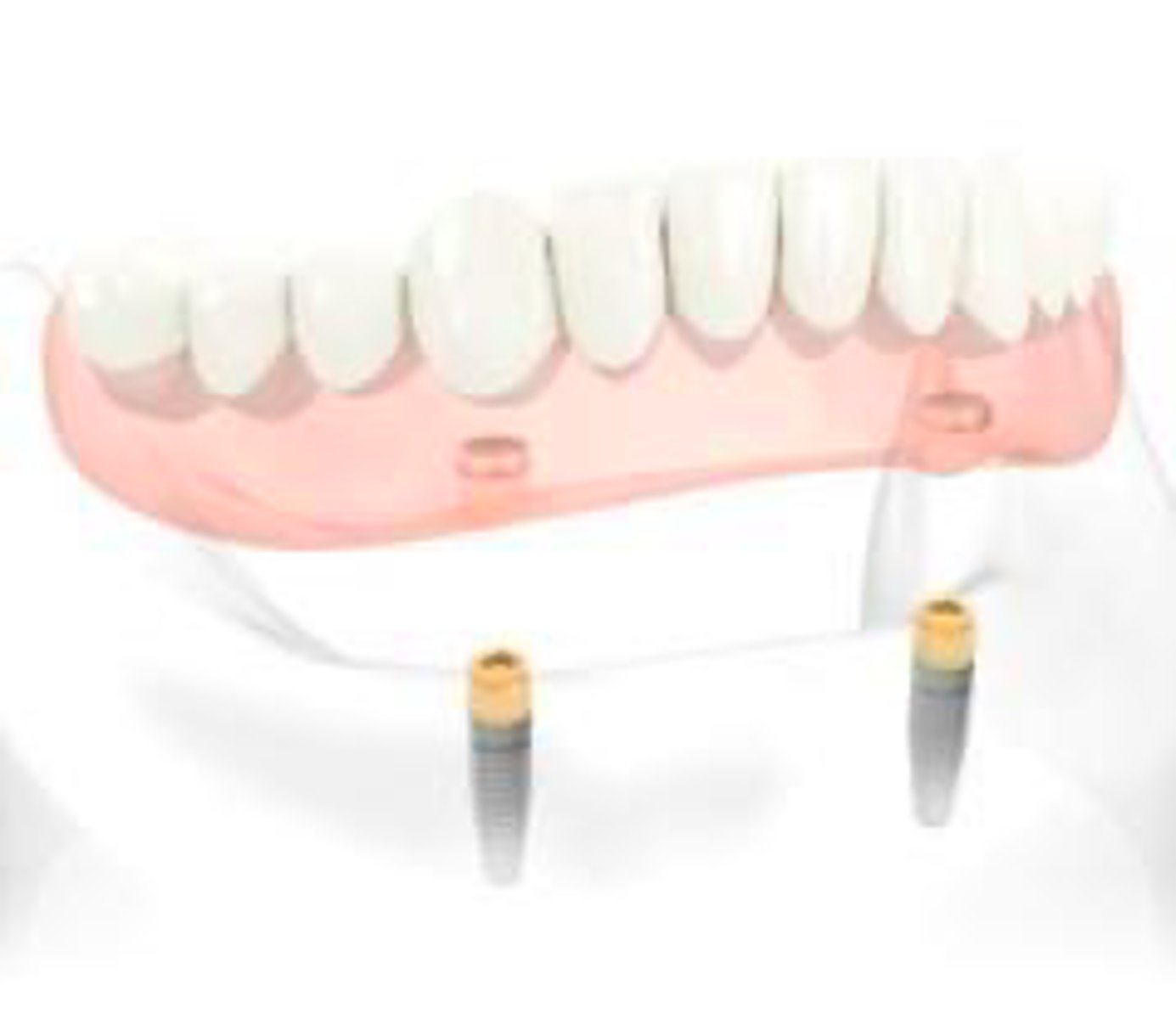 <p>Describe the retention and support for this denture</p>