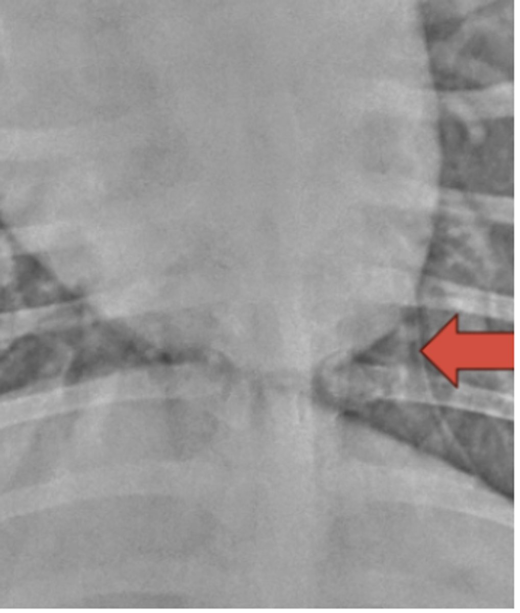 <p>What structure is indicated by the arrow?</p>