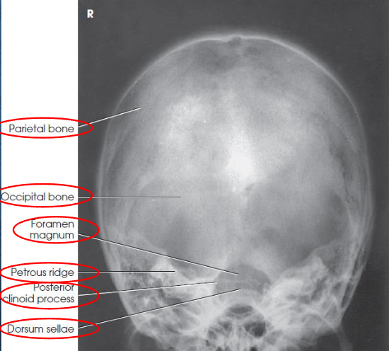 <ul><li><p>no rotation:</p><ul><li><p>equal distance from lateral border of skull to lateral margin of foramen magnum</p></li><li><p>symmetric petrous ridges</p></li></ul></li><li><p>dorsum sellae and posterior clinoid process visible within foramen magnum</p></li><li><p>penetration of occipital bone without excessive density at parietals</p></li></ul><p></p>