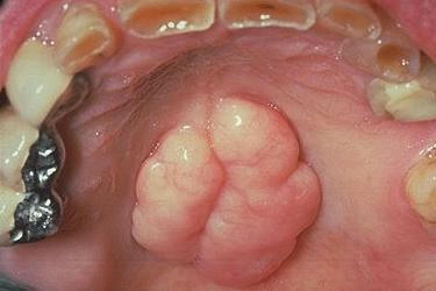 <p>-exophytic growth of normal compact bone</p><p>-clinically in the midline of the hard palate</p><p>-inherited, gradual formation</p><p>-occurs more commonly in women</p><p>-may have various shapes and sizes, lobulated, covered by normal soft tissue</p><p>-no tx unless interfere with speech, swallowing, or prosthesis is needed</p>