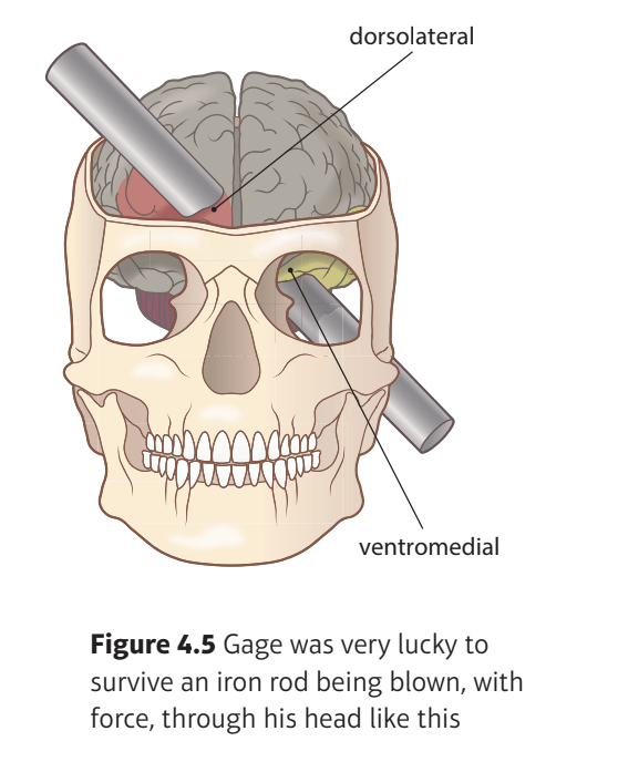 <ol><li><p>Found damage in both the right + left hemispheres of the frontal lobe in Gage’s brain was likely</p></li><li><p>Brain damage in the accident only affected the frontal lobe</p></li><li><p>Iron bar passed through the left eye socket and upwards through the head</p><ul><li><p>So there was more damage to the underlying white matter in the left hemisphere than in the right frontal lobe</p></li></ul></li><li><p>Damaging this area meant Gage was unable to pass neural messages in this part of his brain, making it useless</p></li><li><p>Damage in both hemispheres was worse in the ventromedial region (middle of the underside), but dorsolateral regions (top edges of frontal lobe) were not affected</p></li></ol>