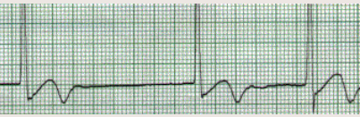 <p>Ritm joncțional</p>