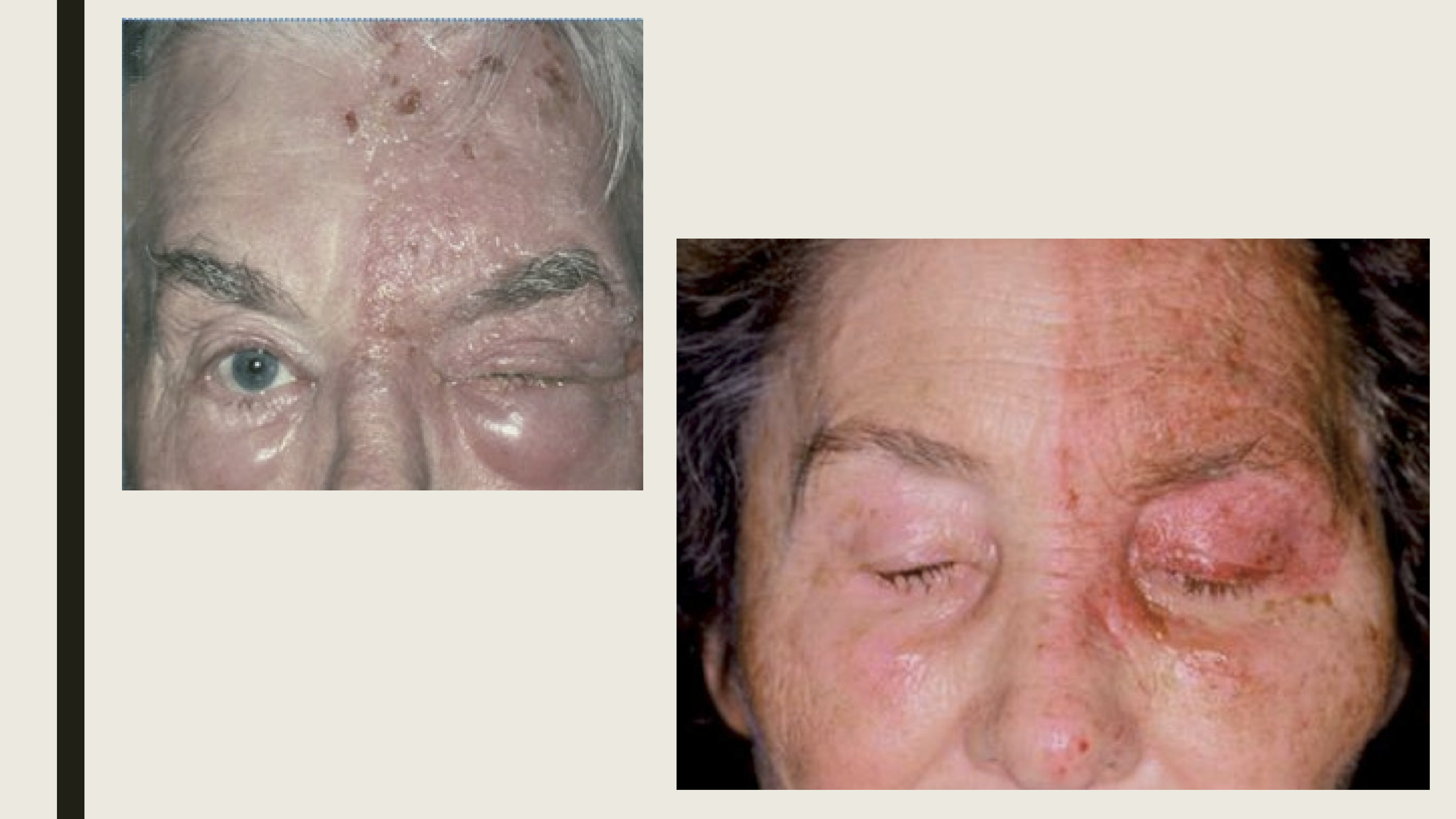 <ul><li><p>Pain along the first division of the trigeminal nerve</p></li><li><p>Maculopapular rash on forehead</p></li><li><p>Vesicles and pustules</p></li><li><p>Eyelid edema</p></li><li><p>Tends to be unilateral</p></li></ul><p></p>
