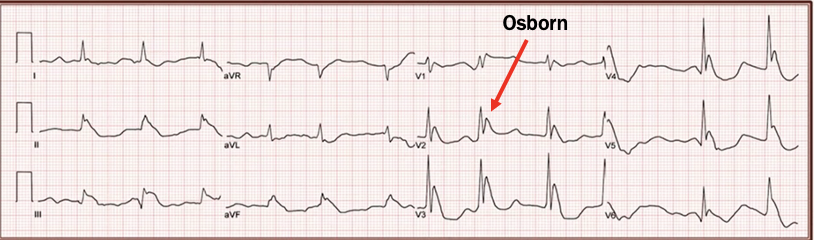 <p>J waves; prolonged PR, QRS, QT; various bradyarrythmias </p>