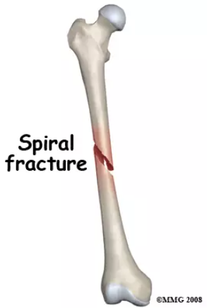 A twisting fracture, also called a torsion or spiral fracture, occurs when a bone is subjected to a twisting or torsional force. This type of fracture results in a spiraling break along the bone's length, often seen in sports-related injuries or accidents.