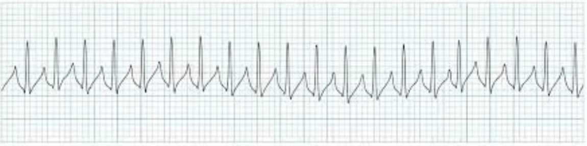 <p>regular, narrow, HR &gt;100 (usually &gt;150); no P or retrograde P waves</p>
