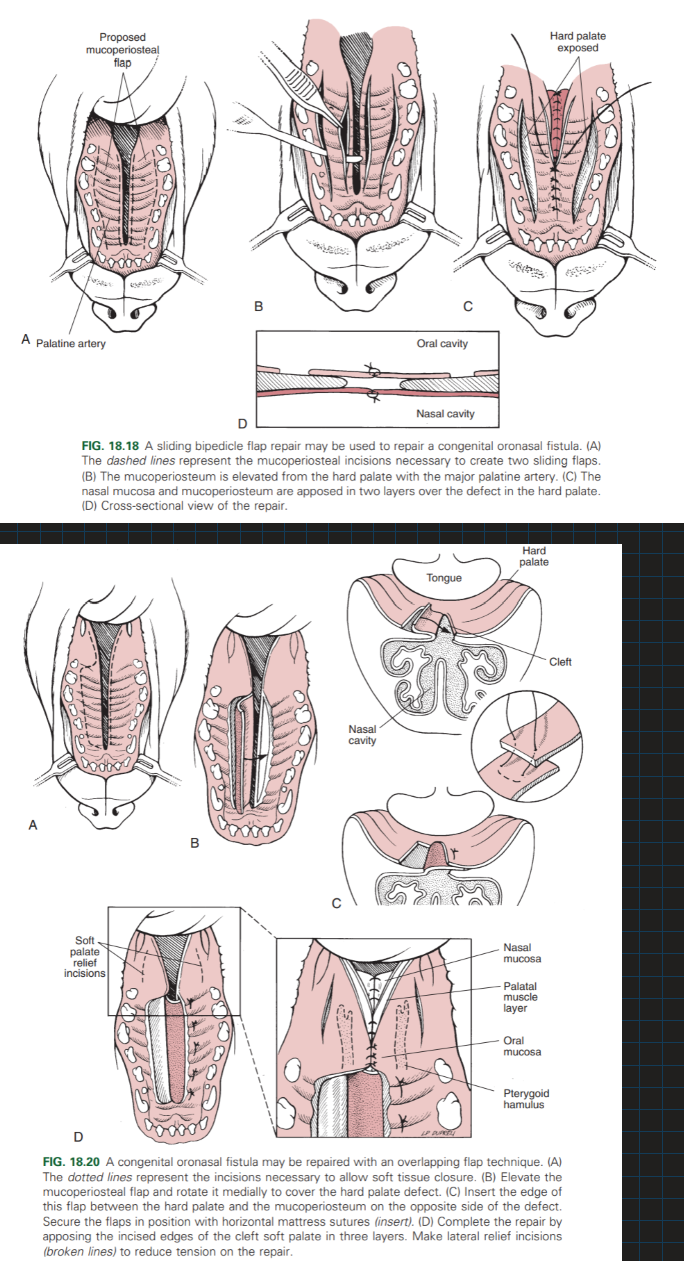 <ol><li><p>Separate the oral and nasal cavities by reconstructing the nasal floor – Suture together airtight. </p></li><li><p>Close opening with an overlapping flap technique or Sliding bipedicle flap repair. </p></li><li><p>Soft palate: suture together or use overlapping flap technique</p></li></ol><p></p>