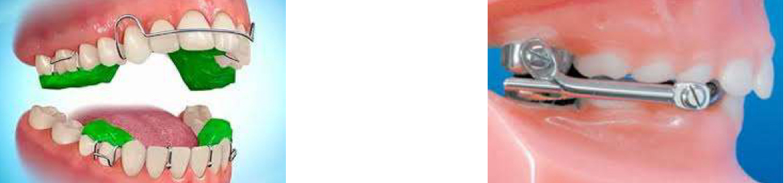 <p>Compliance</p><p>Bulky, difficult to wear, must remove to eat and clean&nbsp;</p><p>Used less in US- favour fixed functional- herbst, Mara</p>