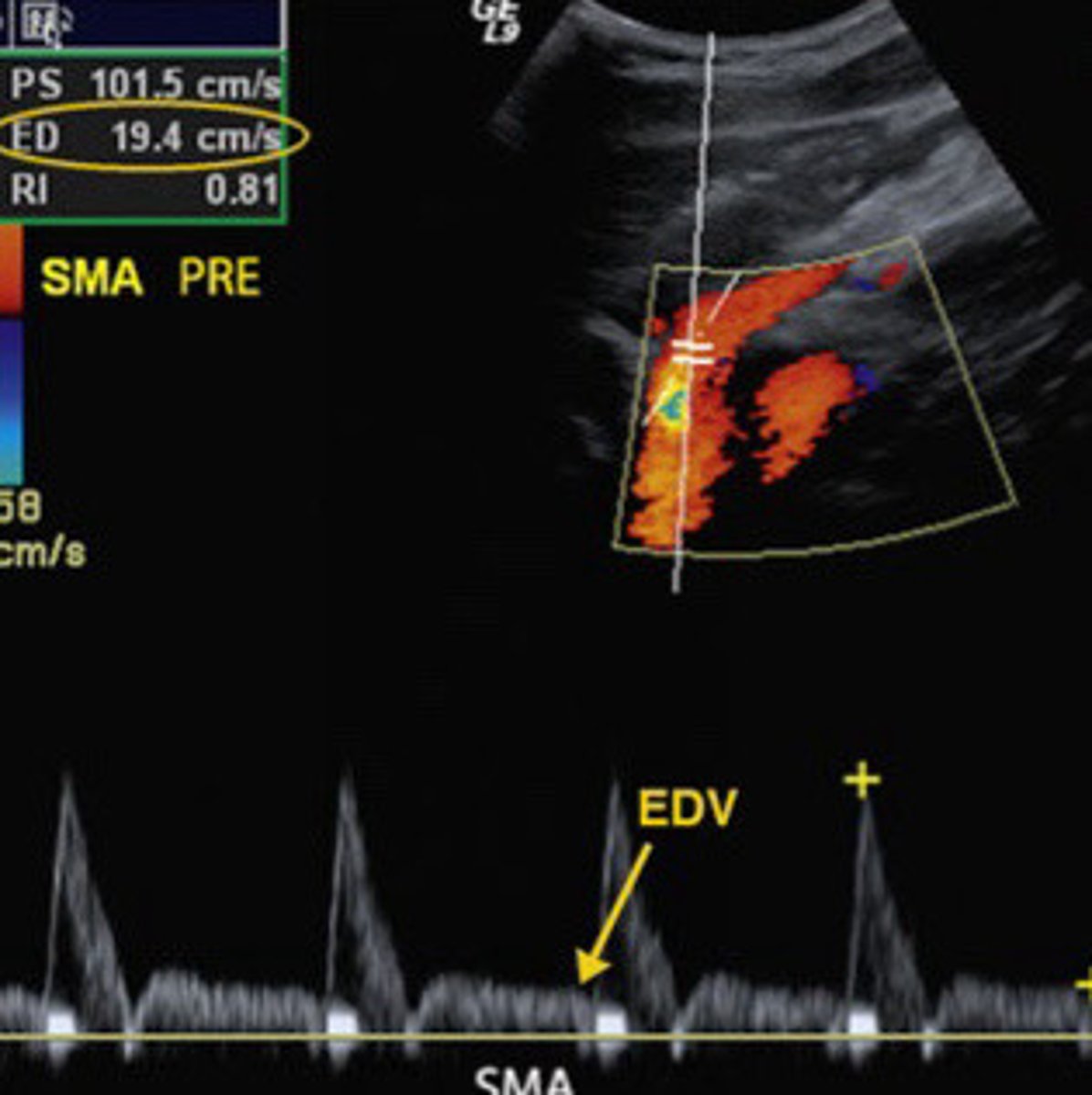 <p>Is this image taken form the SMA most likely from a patient who is pre-prandial or post-prandial</p>